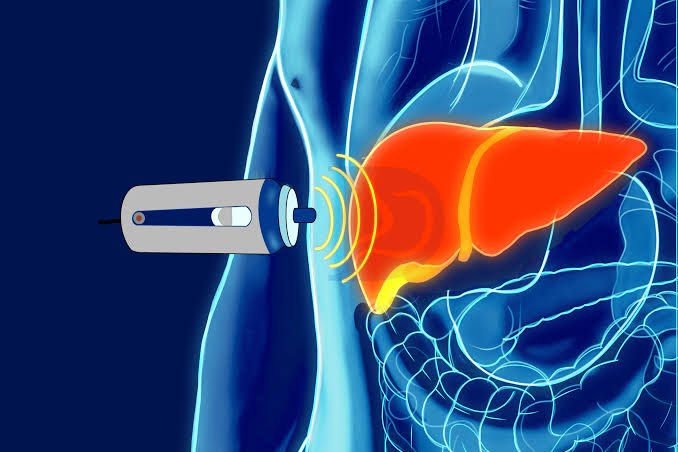 Image of Fibroscan 