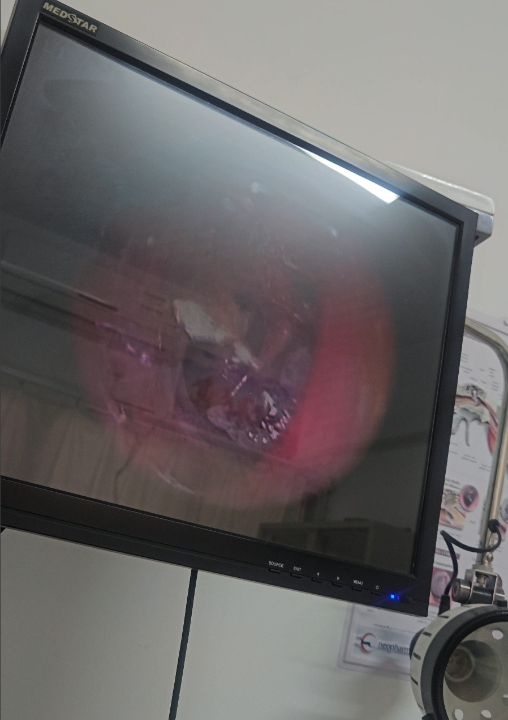 Image of Ear wax Removal